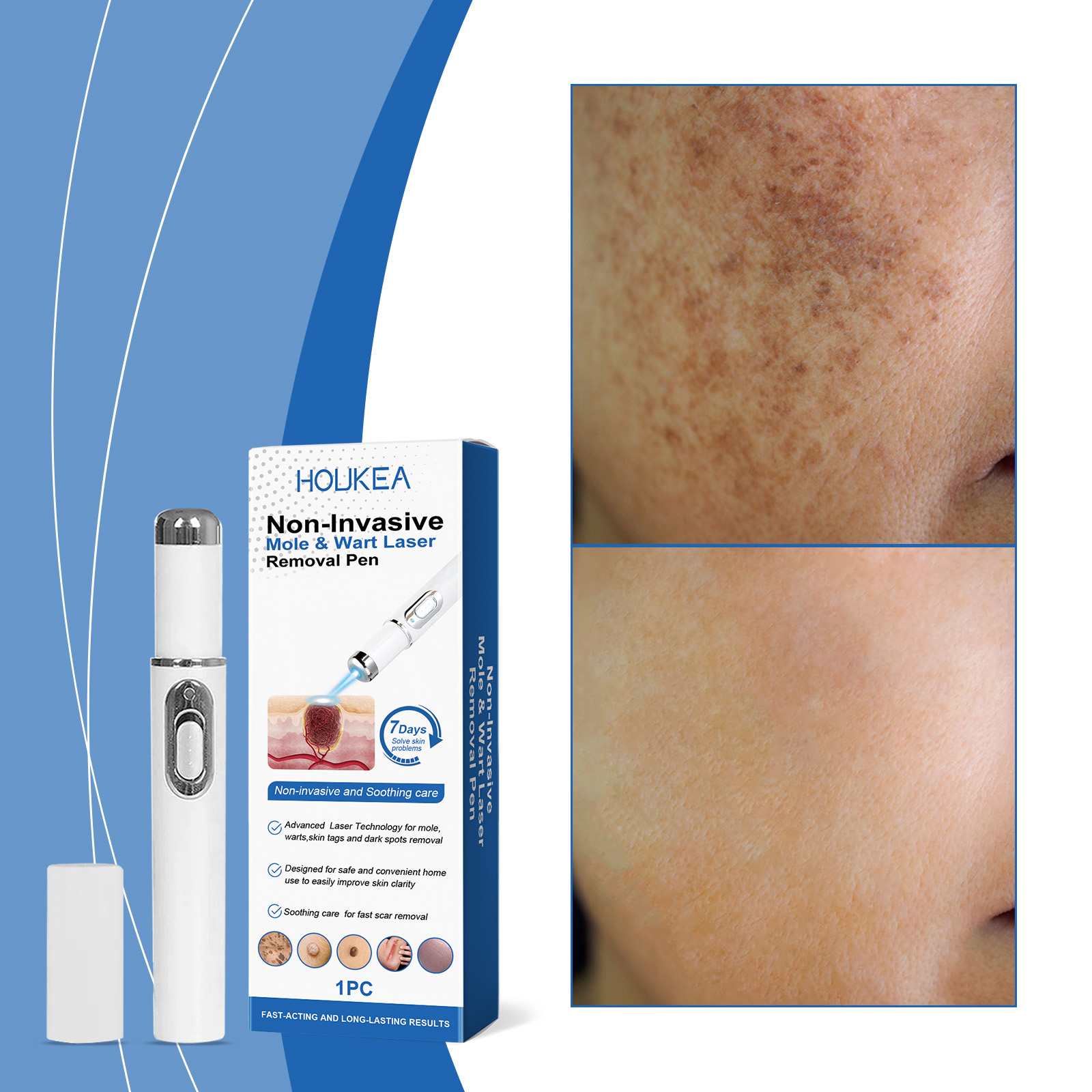 Professional Blue Light Acne Therapy Laser Pen - Portable Skin Blemish & Wrinkle Remover